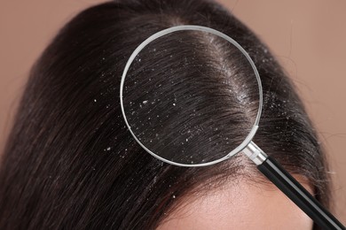 Woman suffering from dandruff on pale brown background, closeup. View through magnifying glass on hair with flakes