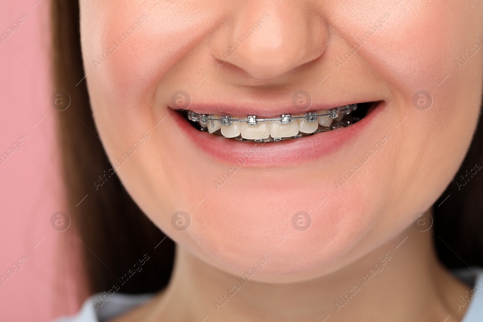 Photo of Smiling woman with dental braces on pink background, closeup
