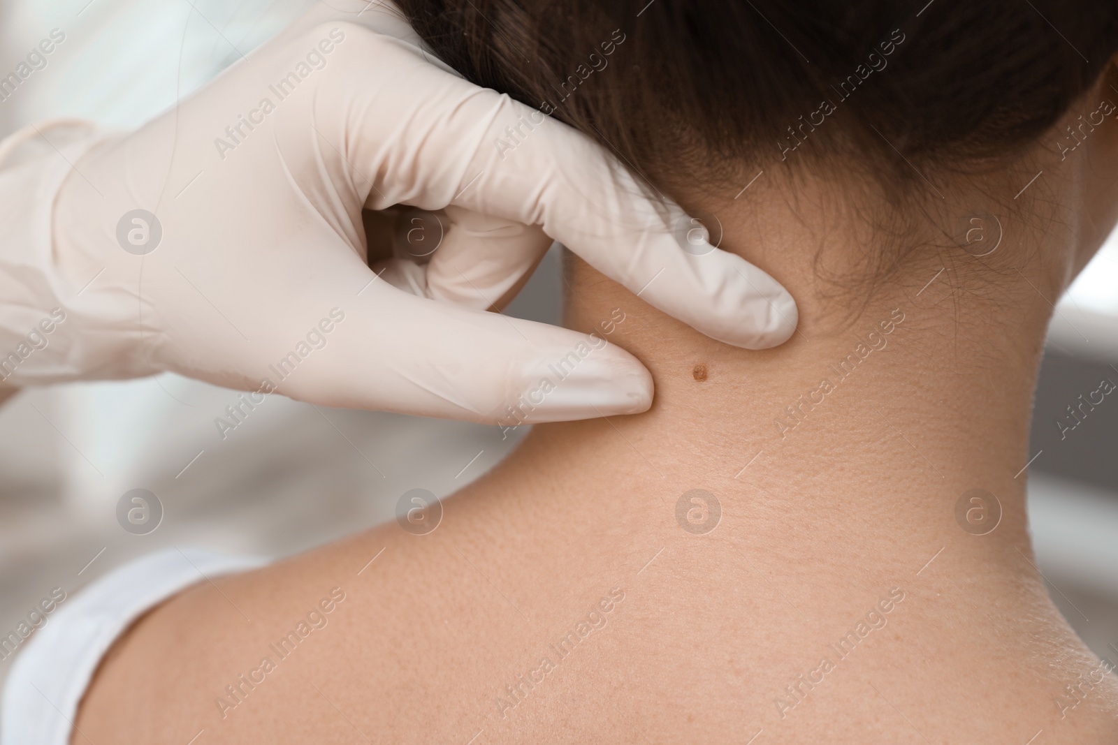 Photo of Dermatologist examining patient's birthmark in clinic, closeup view