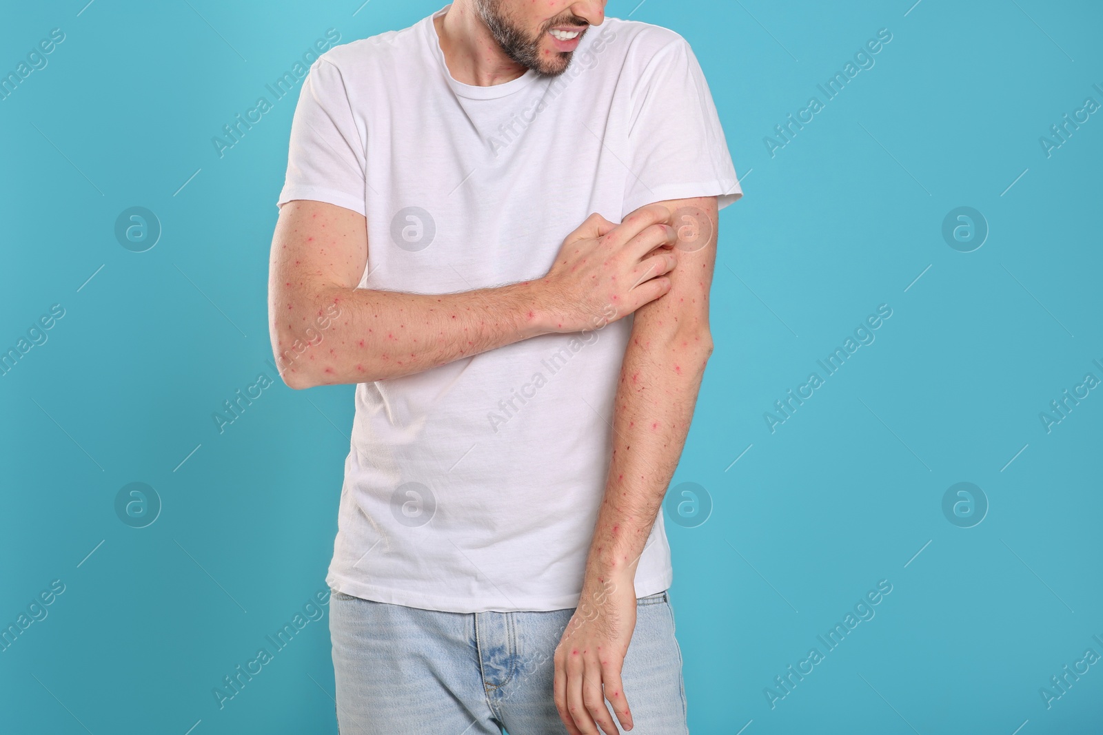 Photo of Man with rash suffering from monkeypox virus on light blue background, closeup