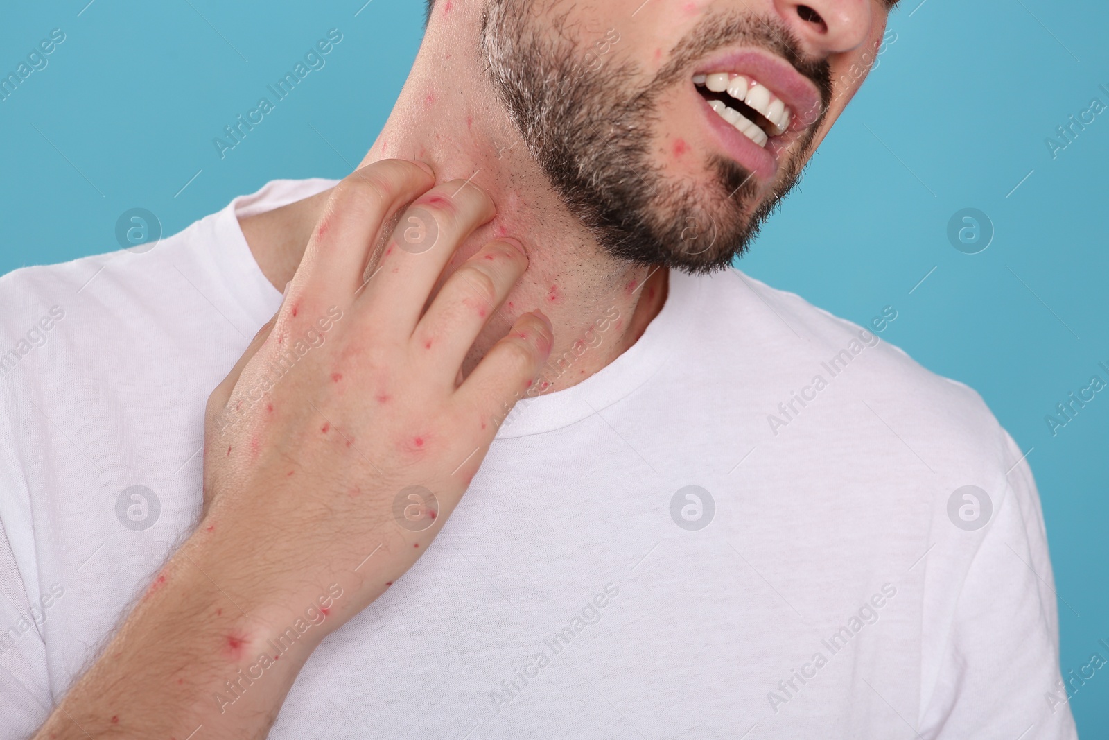 Photo of Man with rash suffering from monkeypox virus on light blue background, closeup