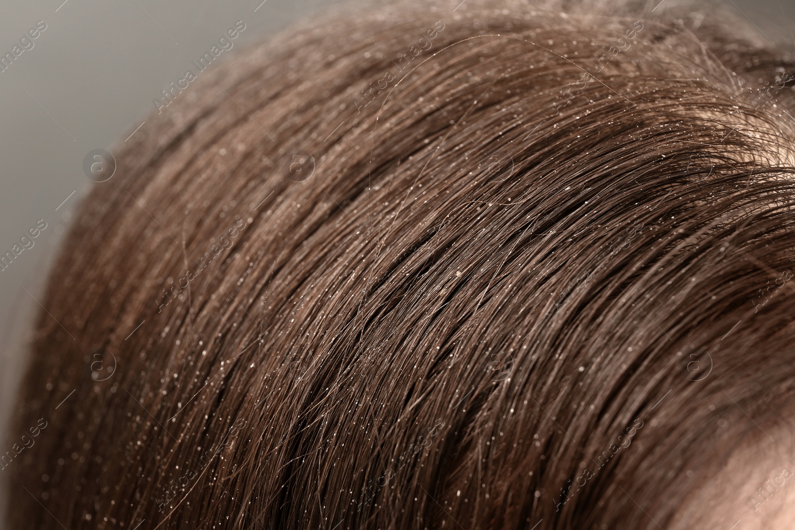 Photo of Woman with dandruff in her dark hair, closeup view