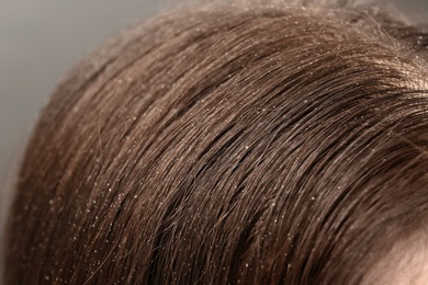 Photo of Woman with dandruff in her dark hair, closeup view