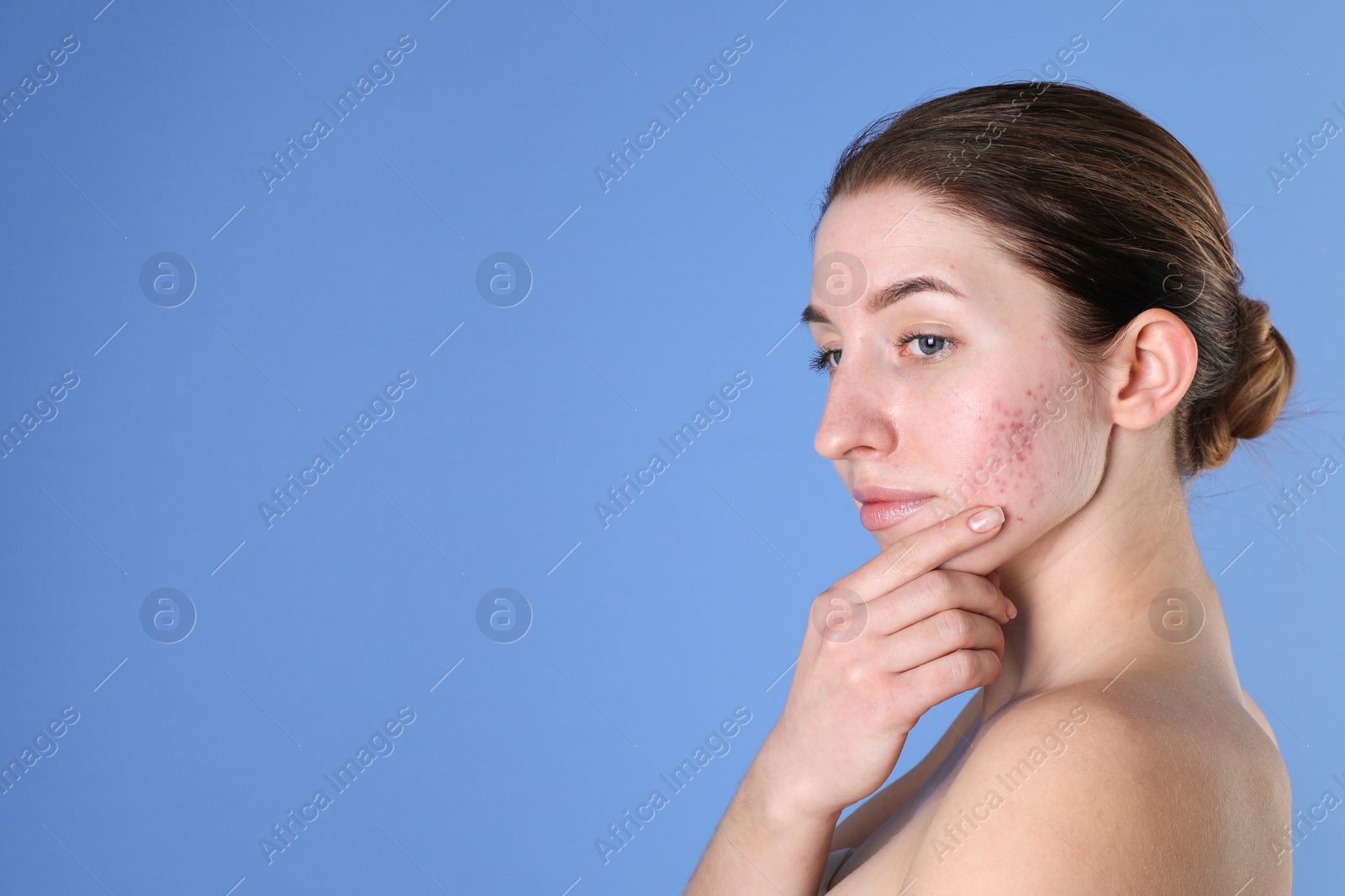 Photo of Young woman with acne problem on blue background. Space for text