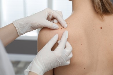 Photo of Dermatologist examining patient's birthmark in clinic, closeup view