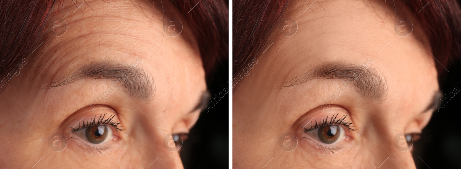 Image of Mature woman before and after skin tightening treatments. Collage with photos on black background, closeup