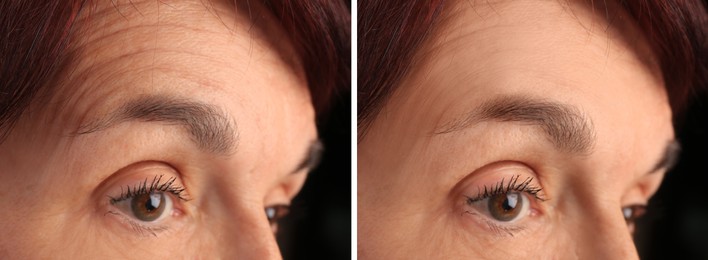 Image of Mature woman before and after skin tightening treatments. Collage with photos on black background, closeup