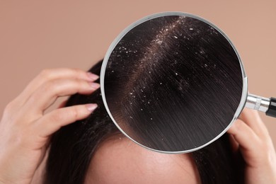 Woman suffering from dandruff on pale brown background, closeup. View through magnifying glass on hair with flakes