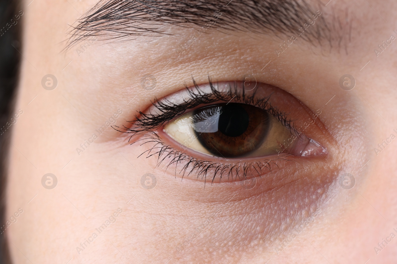 Photo of Woman with yellow eyes, closeup. Symptom of hepatitis