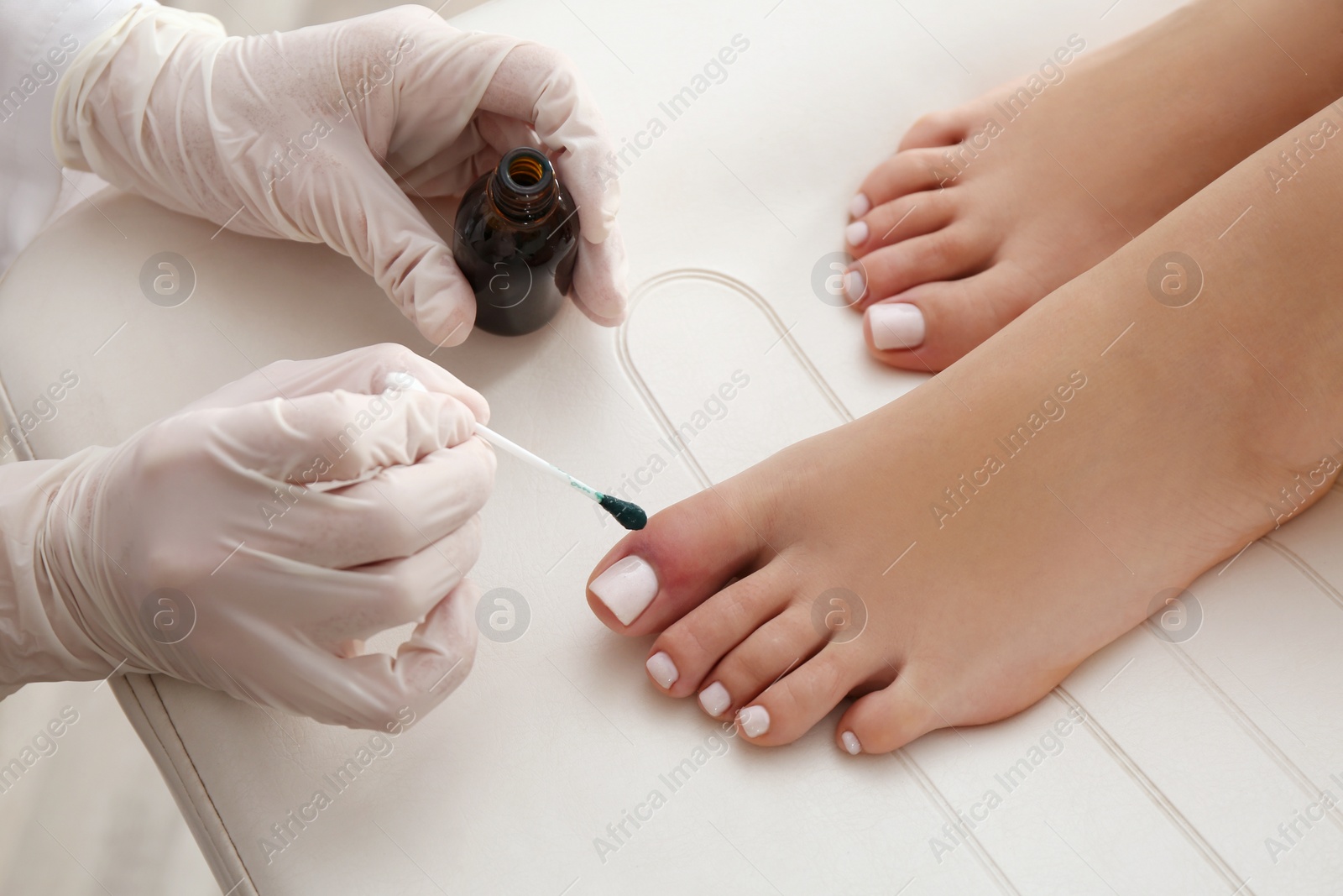 Photo of Doctor applying brilliant green onto injured foot, closeup