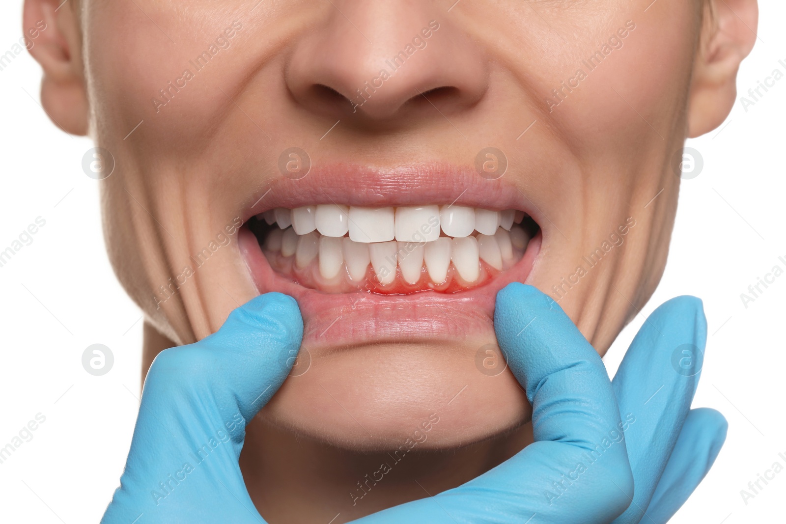 Image of Doctor examining woman's inflamed gum on white background, closeup