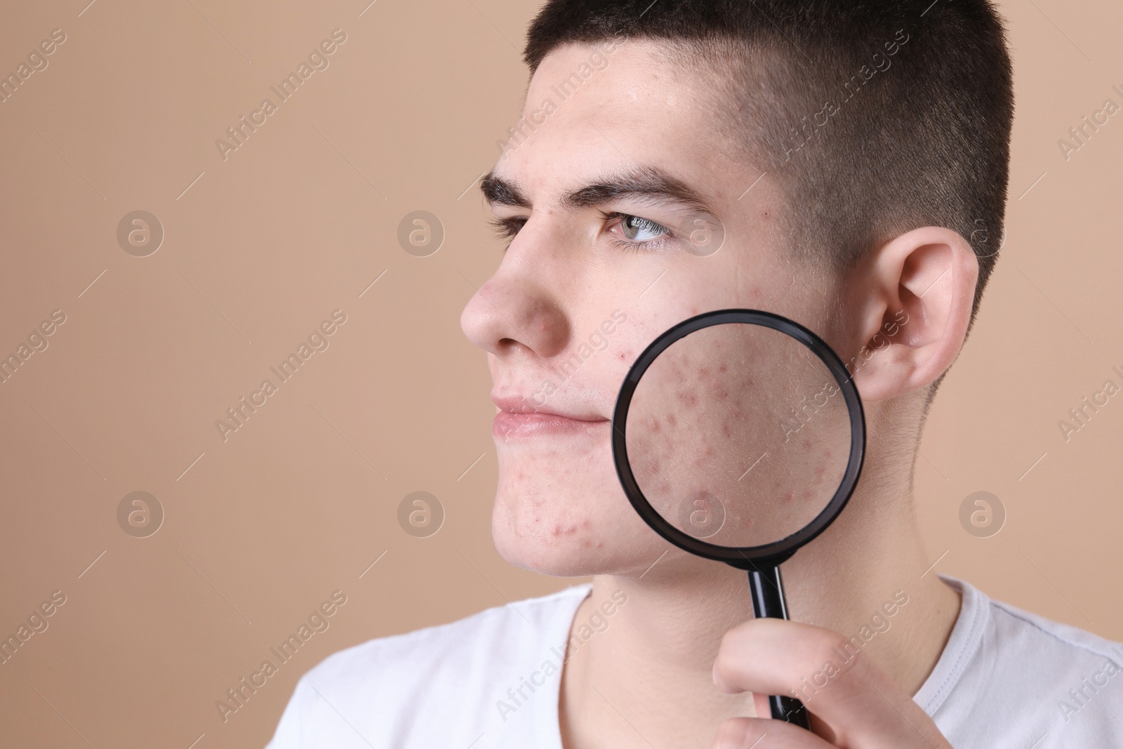 Photo of Young man with acne problem holding magnifying glass on beige background. Space for text