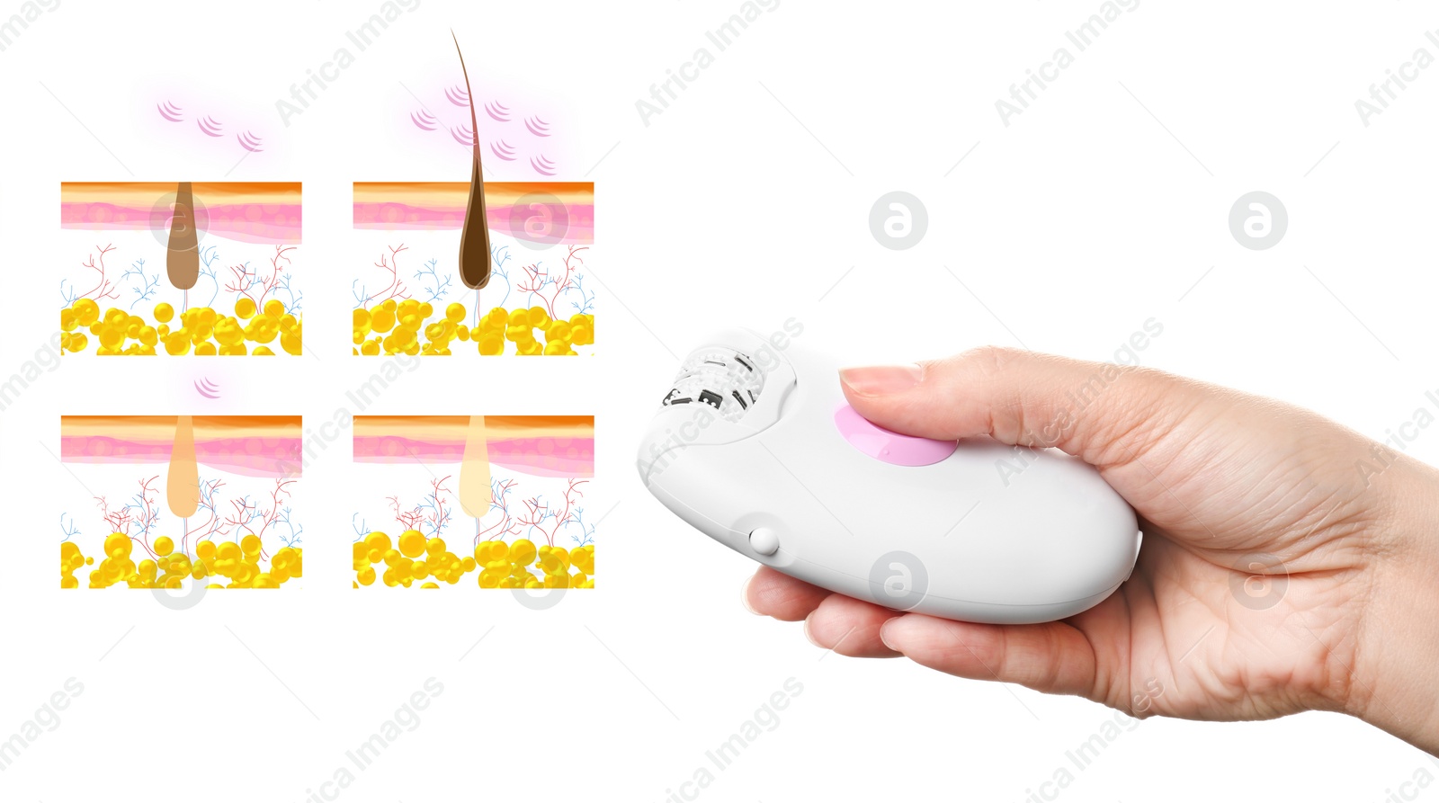 Image of Epilation procedure. Woman holding modern appliance near illustrations of hair follicle on white background, closeup