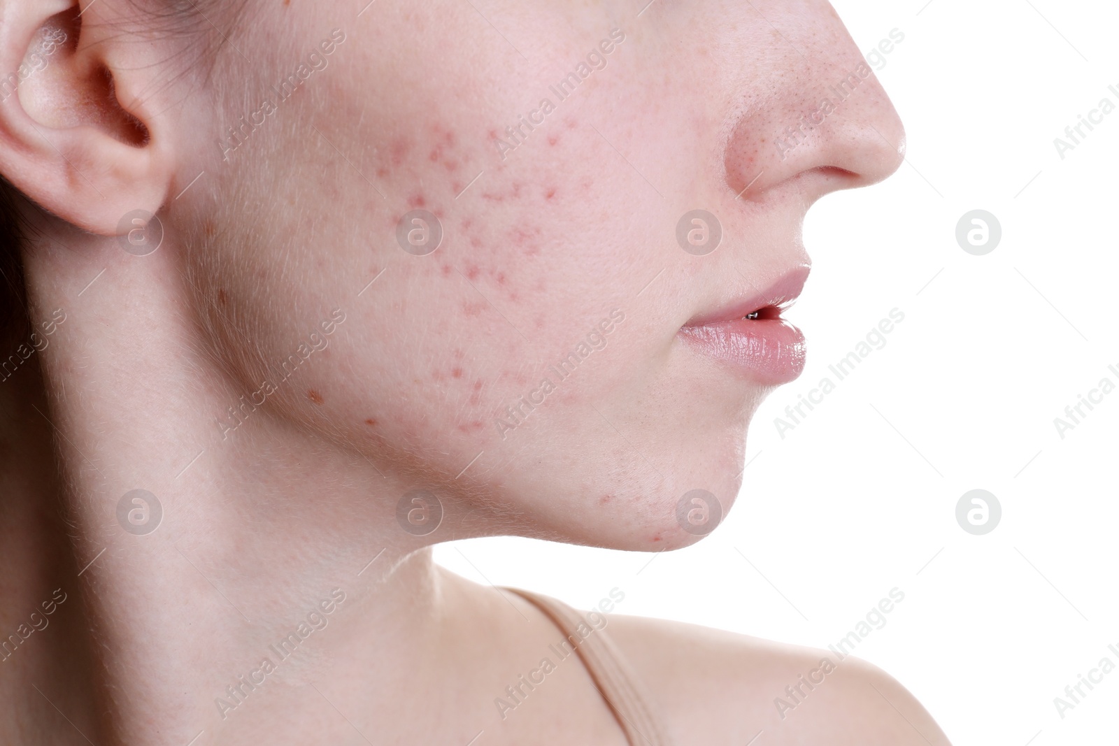 Photo of Young woman with acne problem on white background, closeup