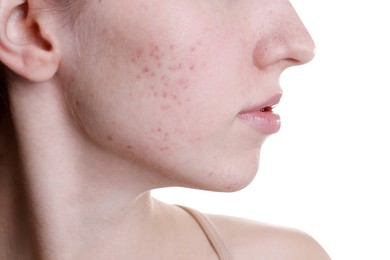 Young woman with acne problem on white background, closeup