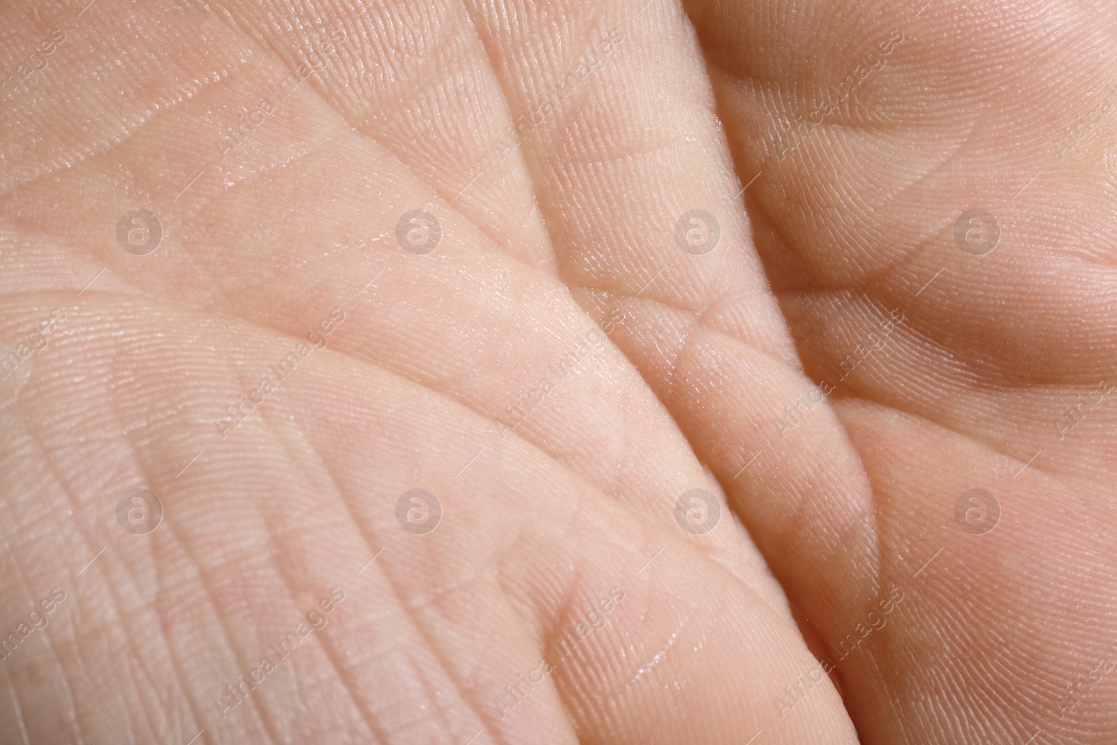 Photo of Closeup view of human hand with dry skin