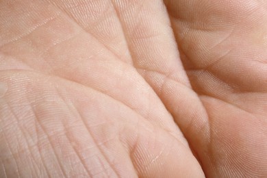 Closeup view of human hand with dry skin
