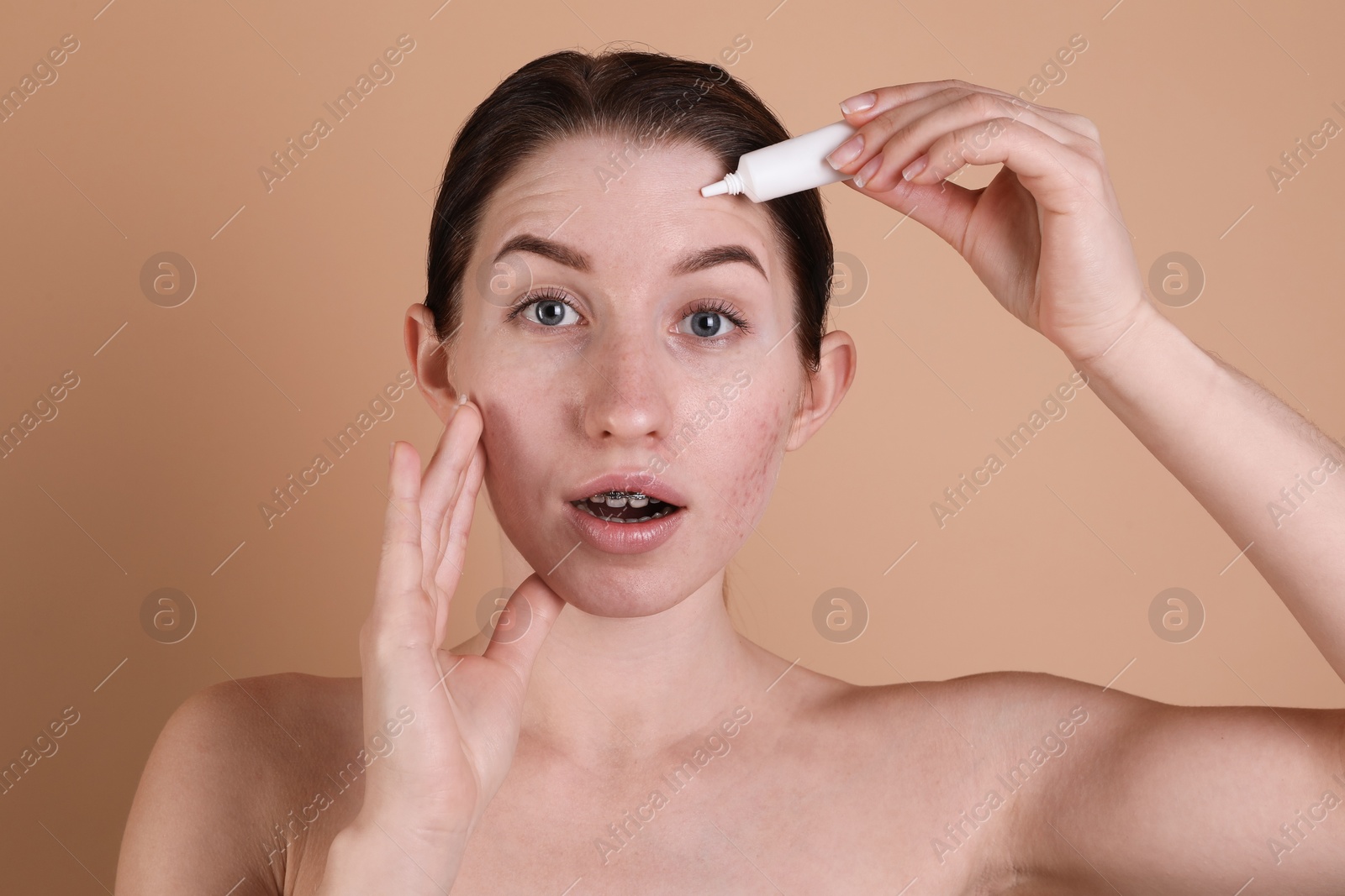 Photo of Emotional young woman with acne problem applying cosmetic product onto her skin on beige background