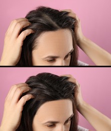 Woman suffering from baldness on pink background, closeup. Collage with photos before and after treatment