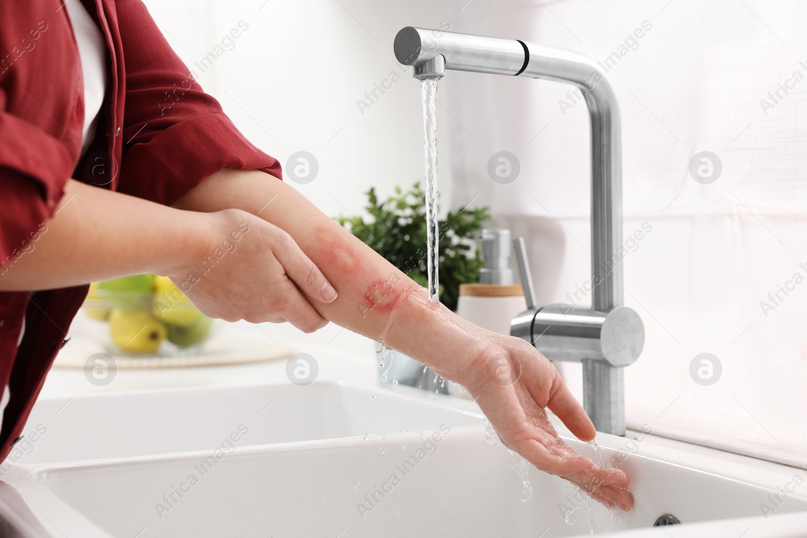 Photo of Woman putting hand with burns under cold running water indoors, closeup