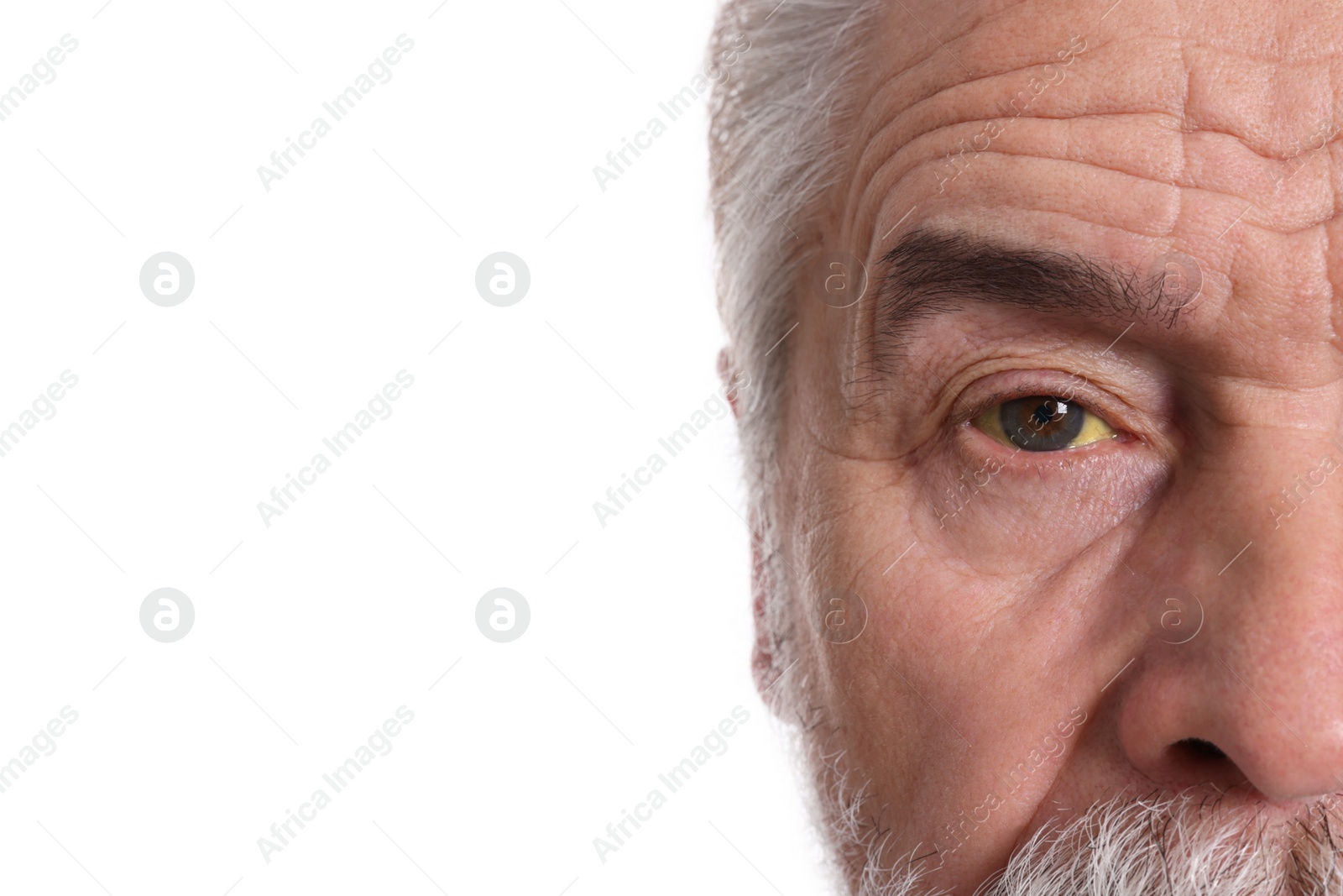 Photo of Senior man with yellow eyes on white background, closeup. Symptom of hepatitis