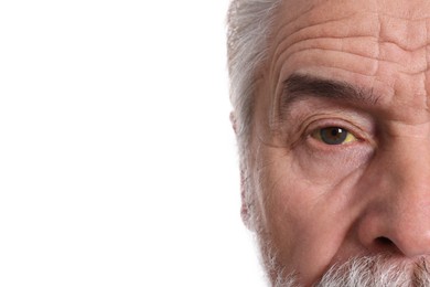 Photo of Senior man with yellow eyes on white background, closeup. Symptom of hepatitis