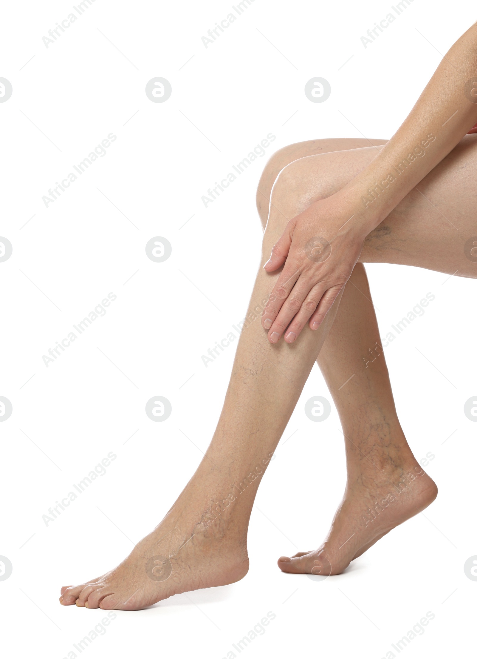 Photo of Closeup view of woman with varicose veins on white background