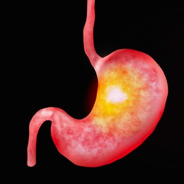 Illustration of  diseased stomach on black background. Gastroenterology