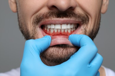 Image of Doctor examining man's inflamed gum on grey background, closeup