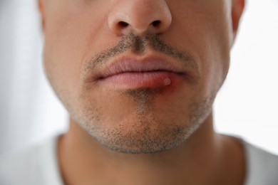 Photo of Man with herpes on lip against light background, closeup