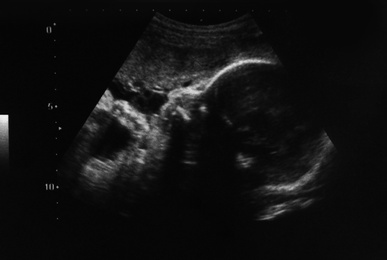 Ultrasound photo of unborn baby in mother's womb, closeup view