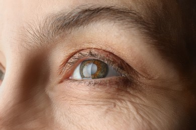 Photo of Closeup view of mature woman with cataract