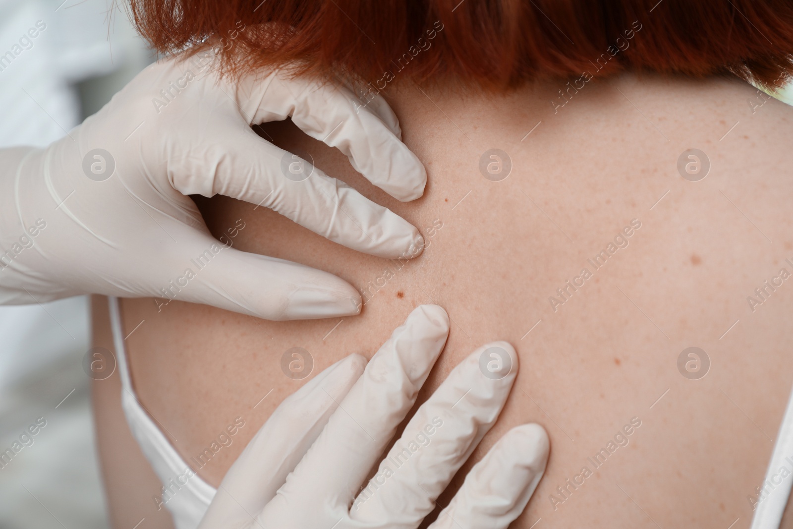 Photo of Dermatologist examining patient's birthmark in clinic, closeup view