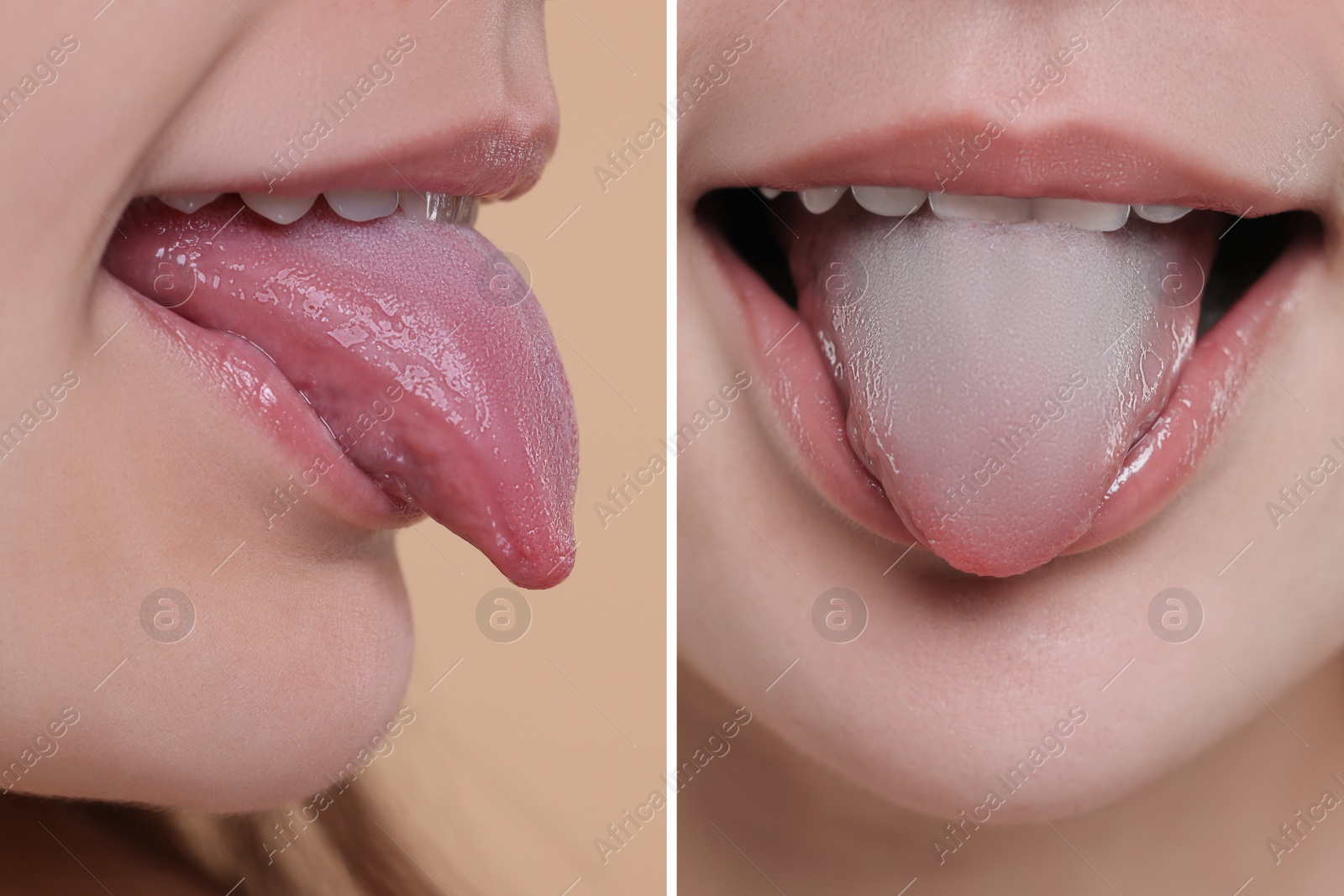 Image of Woman showing her tongue before and after cleaning procedure, closeup. Tongue coated with plaque on one side and healthy on other, collage