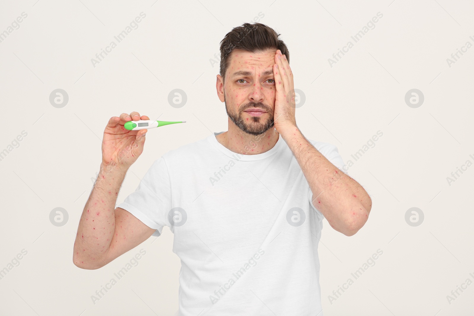 Photo of Man with rash holding thermometer on beige background. Monkeypox virus diagnosis