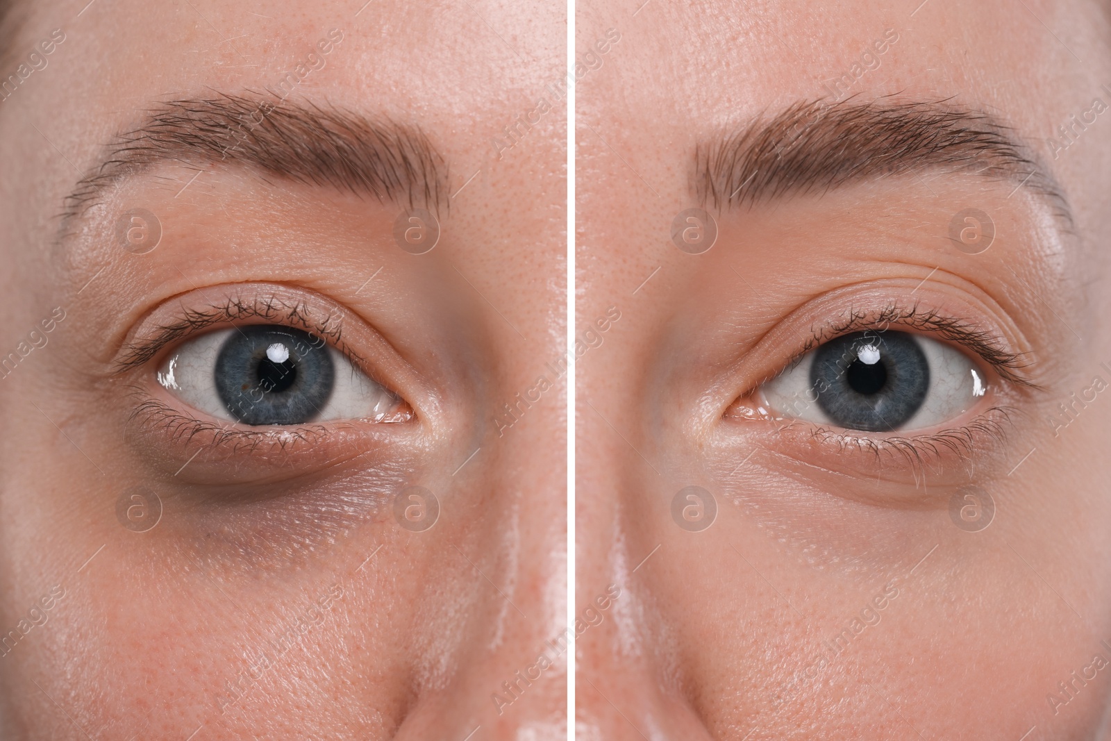 Image of Collage with photos of woman with dark circle under eye before and after treatment, closeup