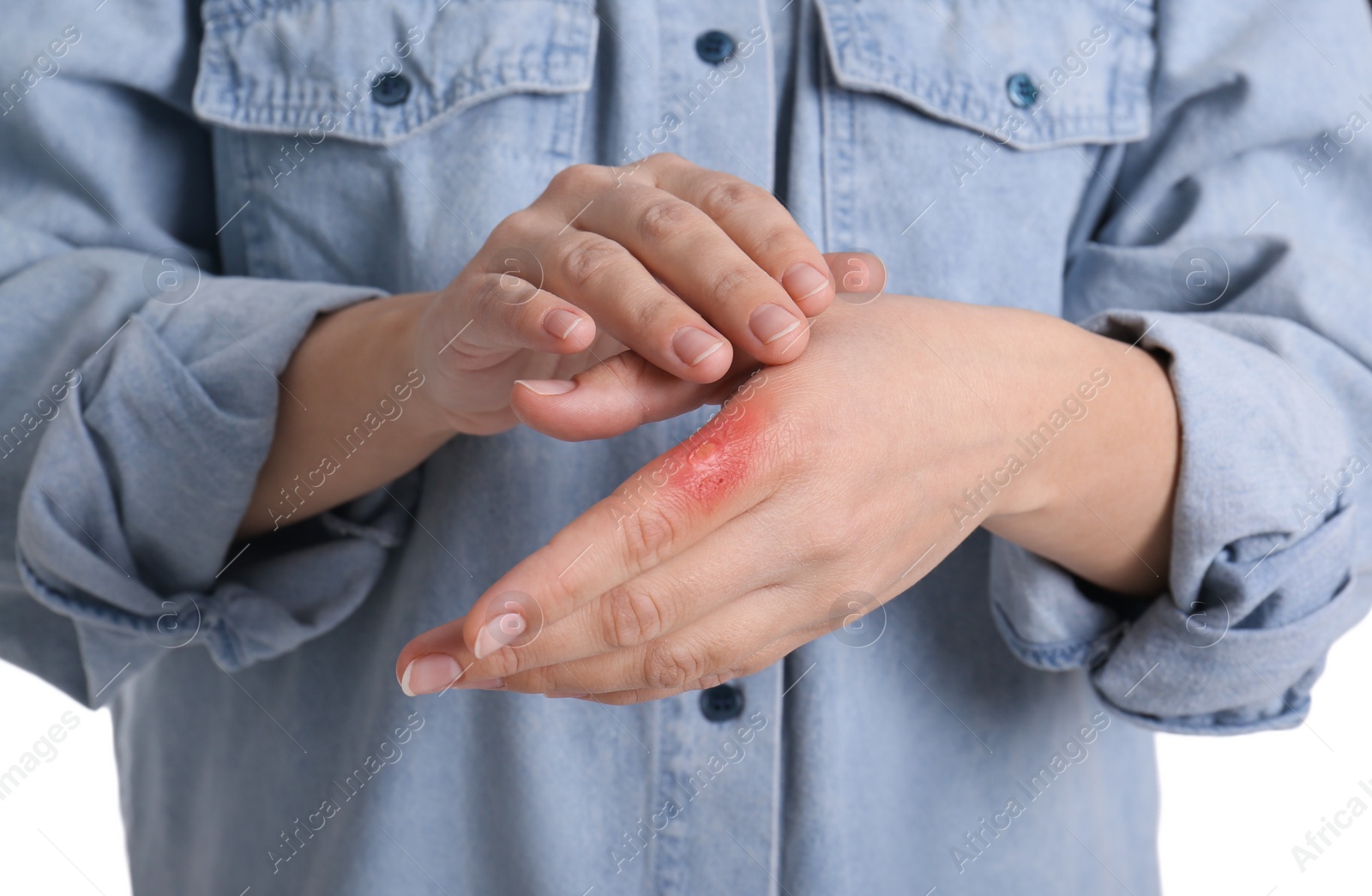 Photo of Woman with burn of her hand on white background, closeup