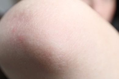 Photo of Woman with dry skin on elbow, closeup