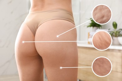 Image of Cellulite problem. Slim woman in underwear at home, closeup. Zoomed skin areas with orange peel syndrome