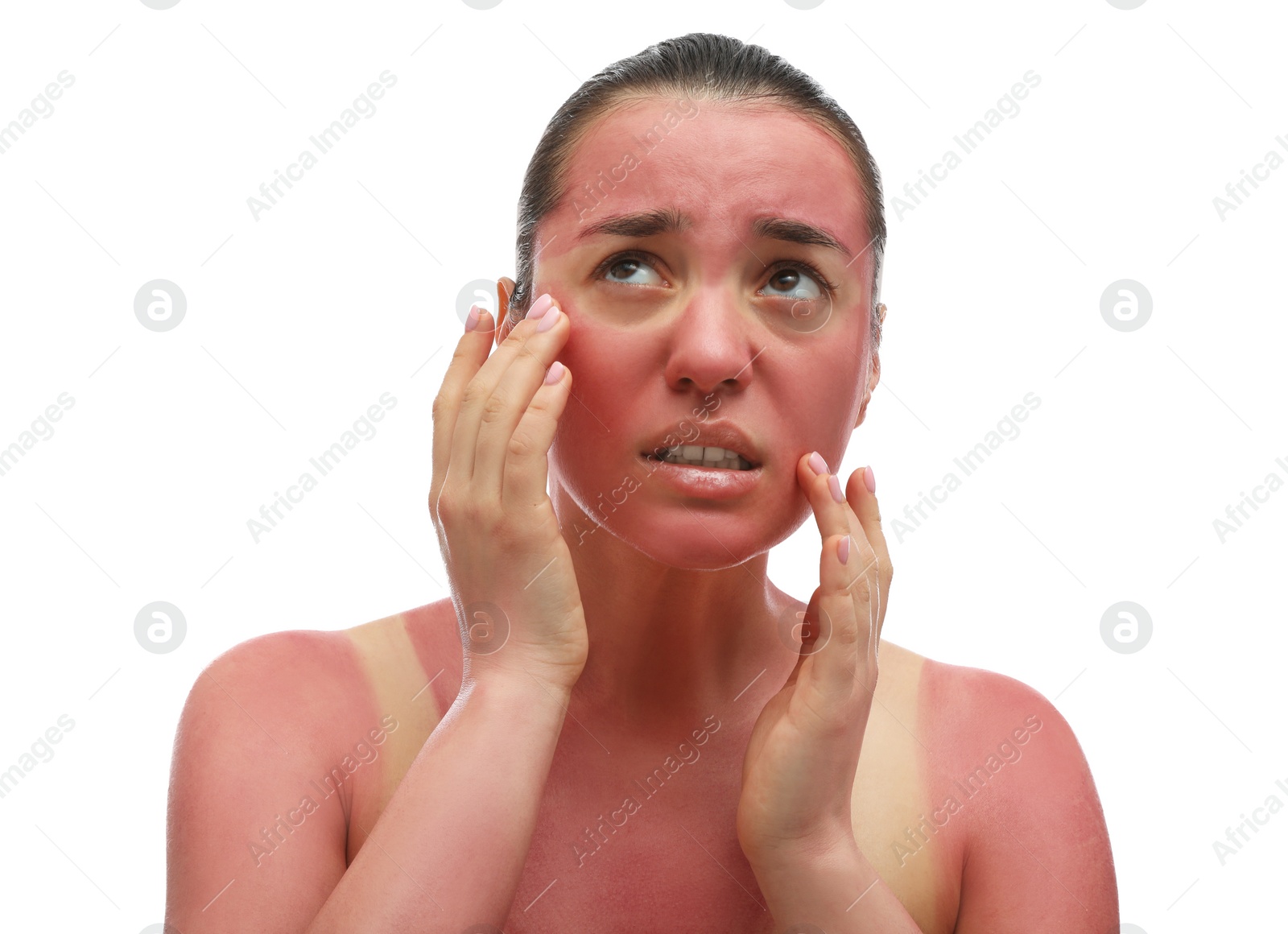 Photo of Woman with sunburned skin on white background