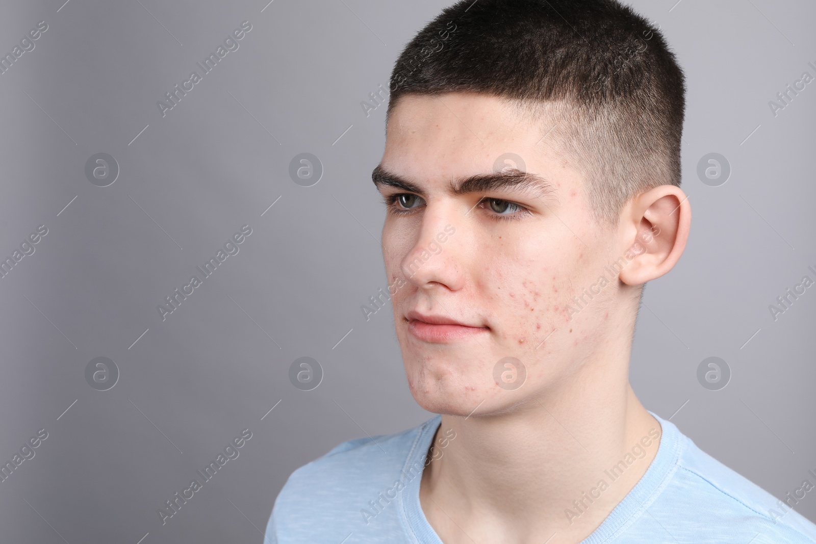 Photo of Young man with acne problem on grey background. Space for text