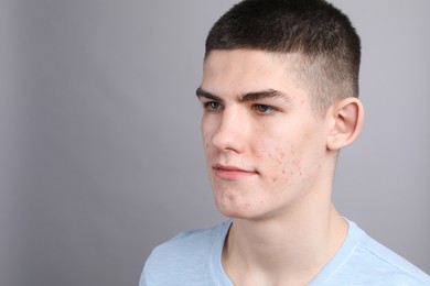 Photo of Young man with acne problem on grey background. Space for text