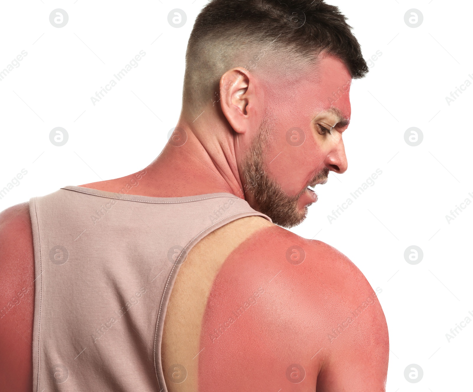 Photo of Man with sunburned skin on white background, back view