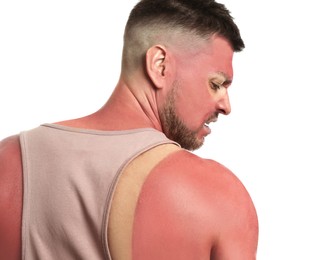 Man with sunburned skin on white background, back view