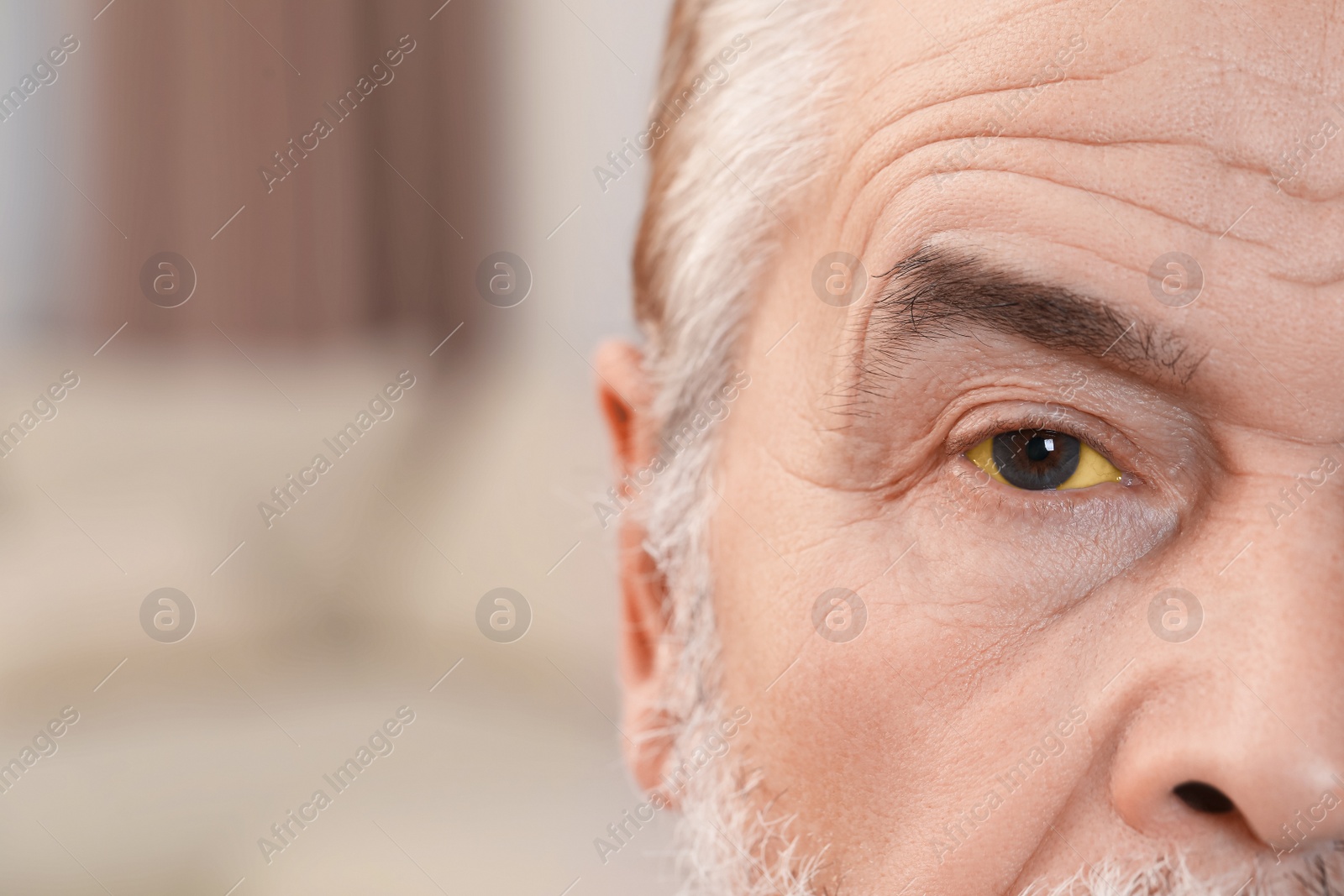 Photo of Senior man with yellow eyes on blurred background, closeup. Symptom of hepatitis