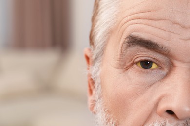 Photo of Senior man with yellow eyes on blurred background, closeup. Symptom of hepatitis