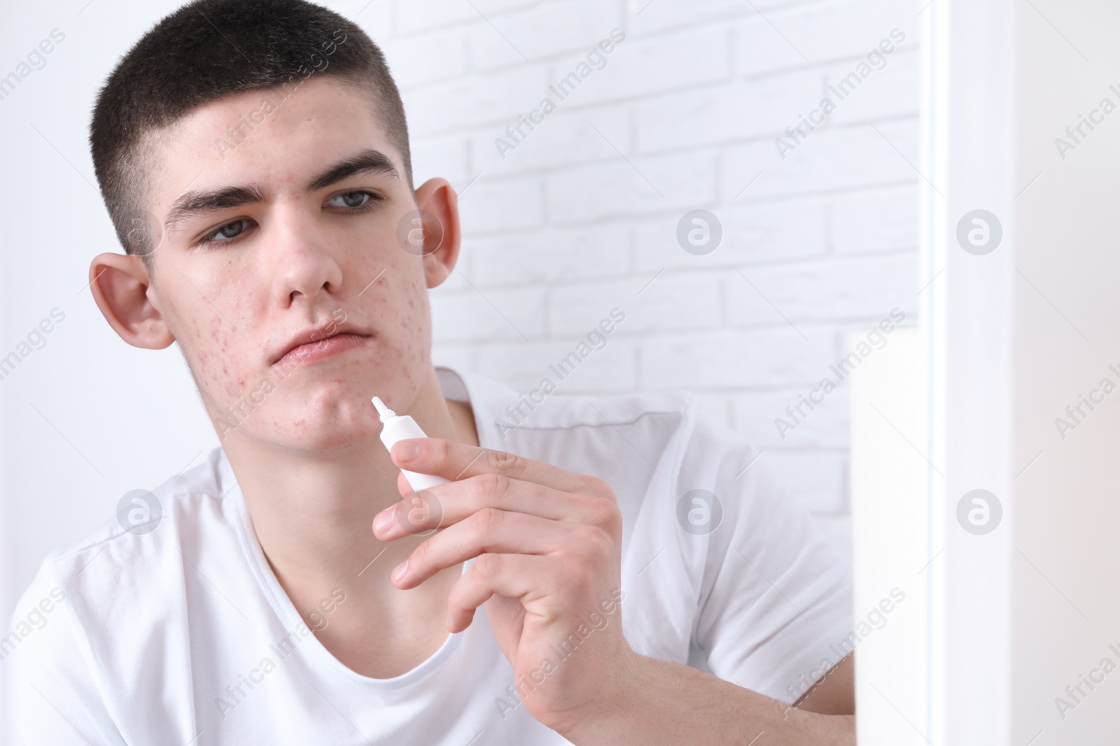 Photo of Young man with acne problem applying cosmetic product onto his skin indoors