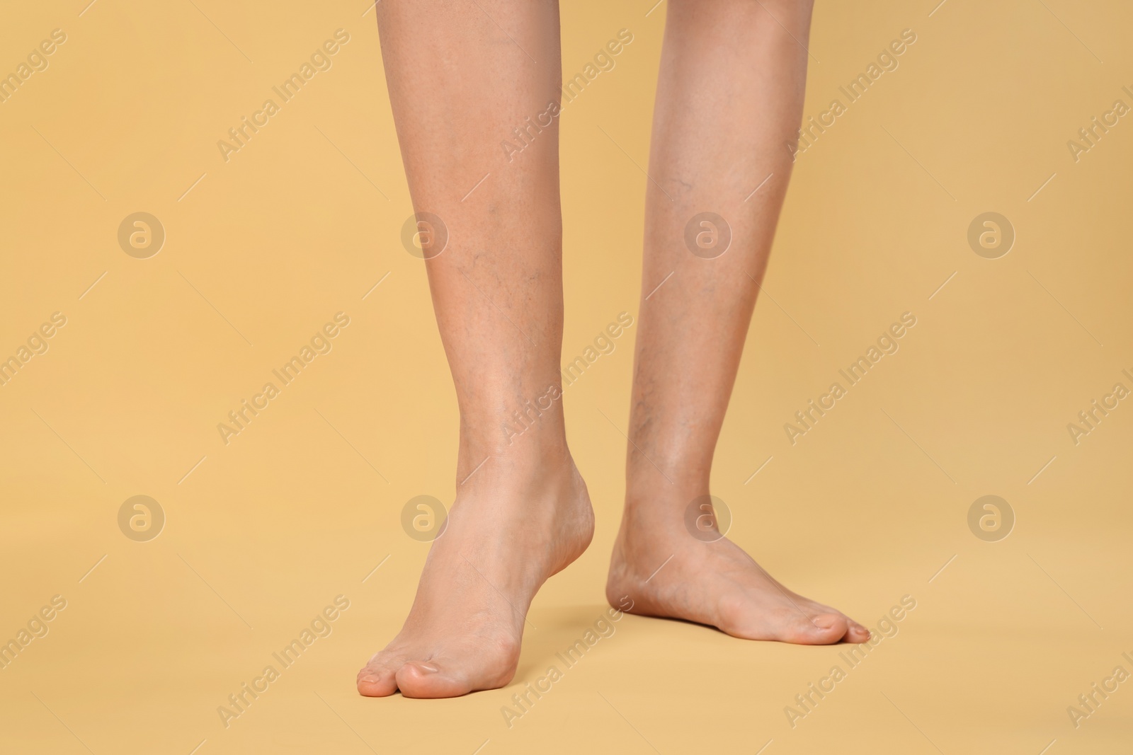 Photo of Closeup view of woman with varicose veins on yellow background