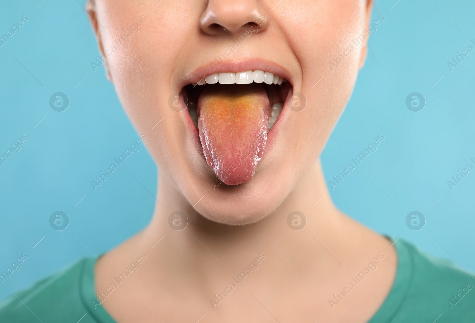 Photo of Gastrointestinal diseases. Woman showing her yellow tongue on light blue background, closeup