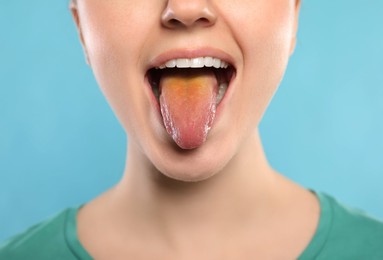 Gastrointestinal diseases. Woman showing her yellow tongue on light blue background, closeup